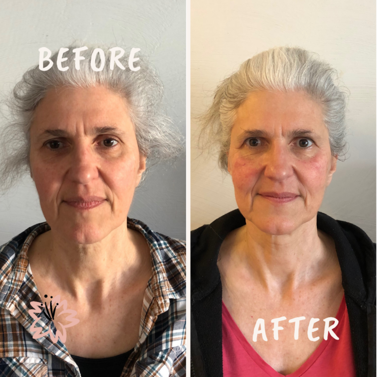Les résultats de plusieurs séances de lifting naturel du visage. La ride du lion s'est atténuée, les paupières supérieures sont rehaussées.