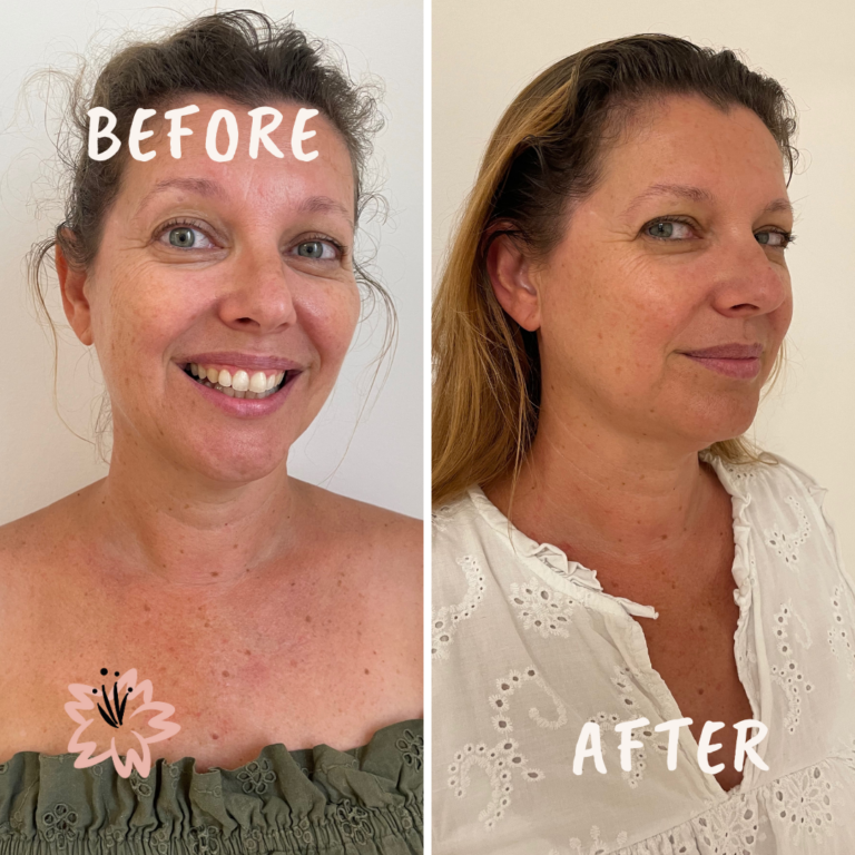 Les résultats du lifting naturel du visage. On voit une diminution des rides de la patte d'oie, de la ride du lion, un coup d'éclat, et un meilleur teint.